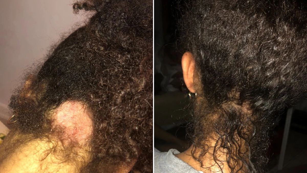 PRP Hair Restoration